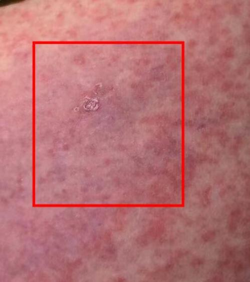 恙虫病皮疹图片像火龙果长在了身上，怎么预防？