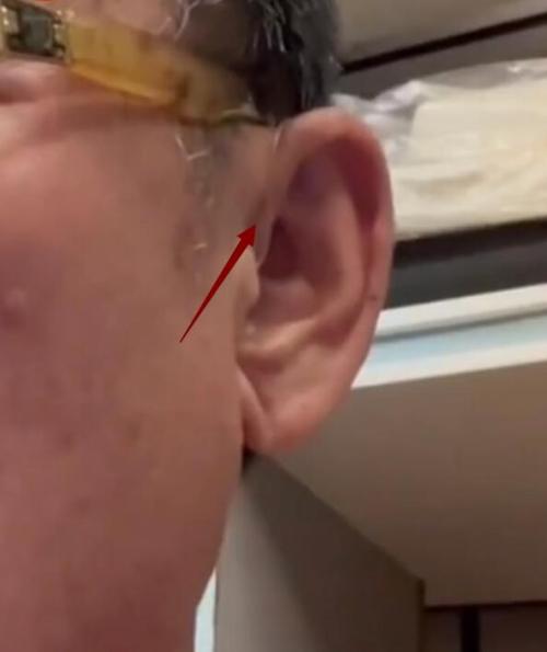 李立群耳朵戴的那根线是什么东西？隐形助听器的线