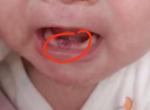 宝宝出世就长牙有牙齿是怎么回事？要拔掉吗？