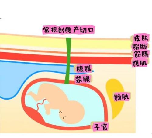腹膜外剖腹产与正常剖腹产的比较哪个好？怎么做的？